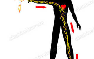 Виды поражения электрическим током